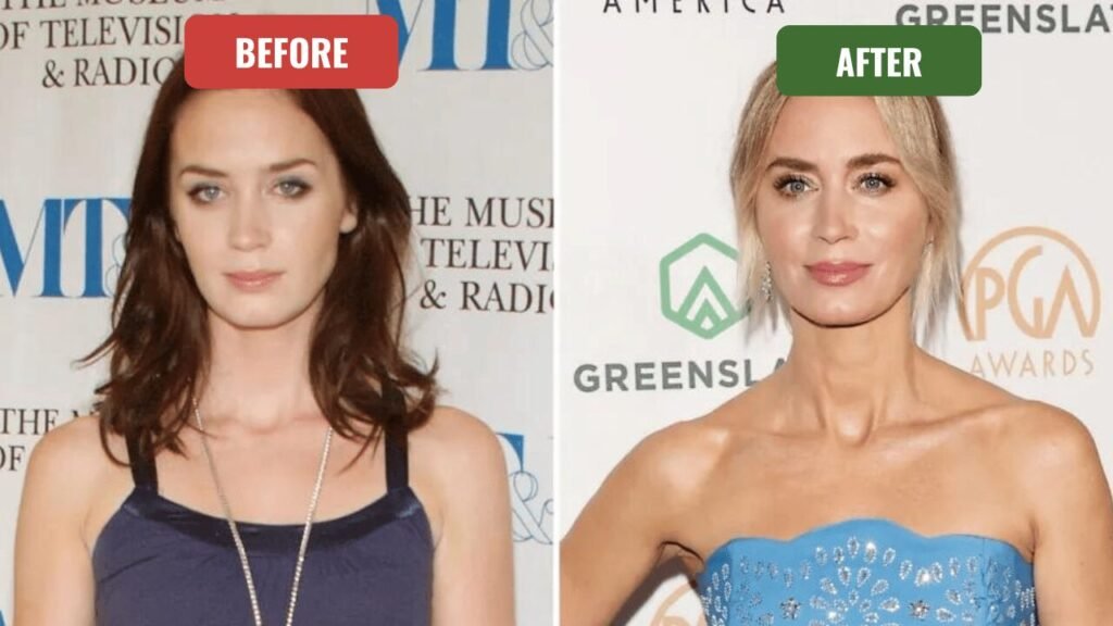 emily blunt plastic surgery