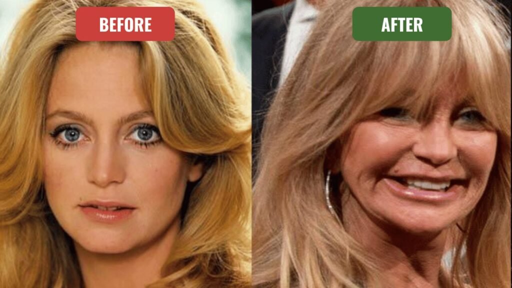 goldie hawn plastic surgery