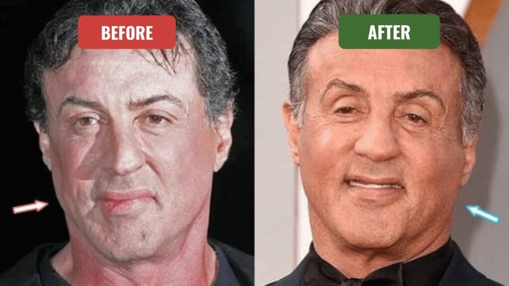 sylvester stallone plastic surgery