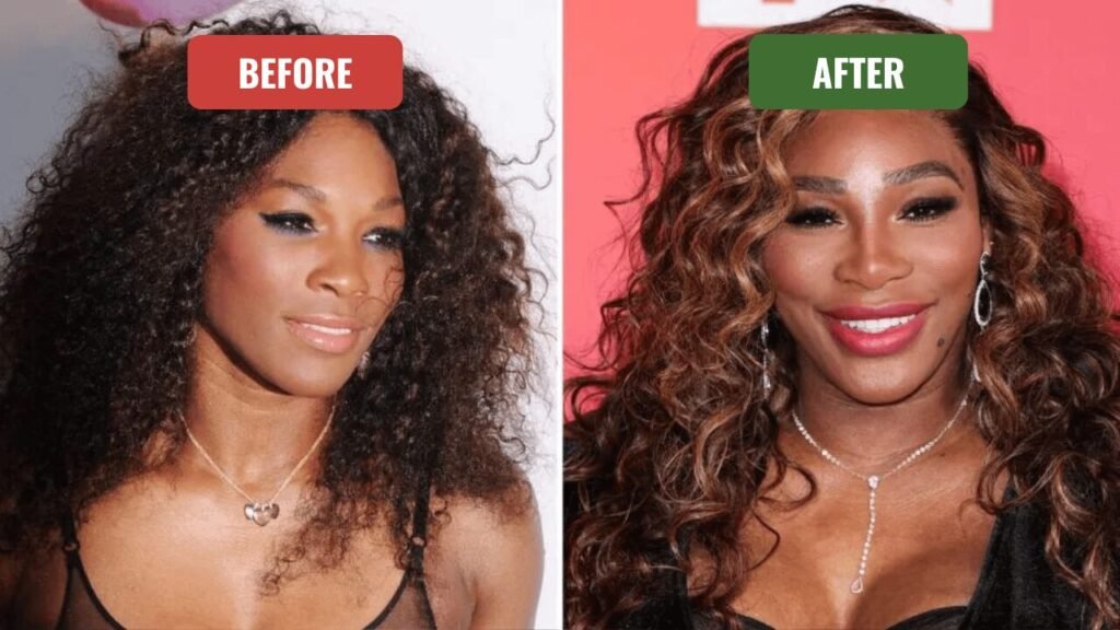 serena williams plastic surgery