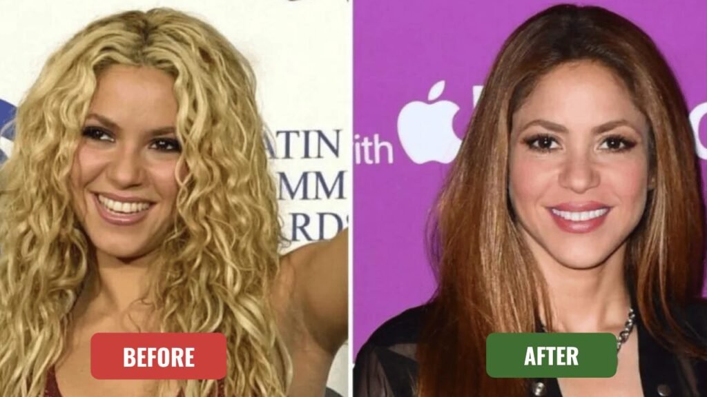 shakira plastic surgery