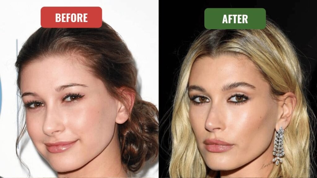 hailey bieber plastic surgery