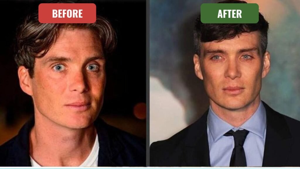 cillian murphy plastic surgery