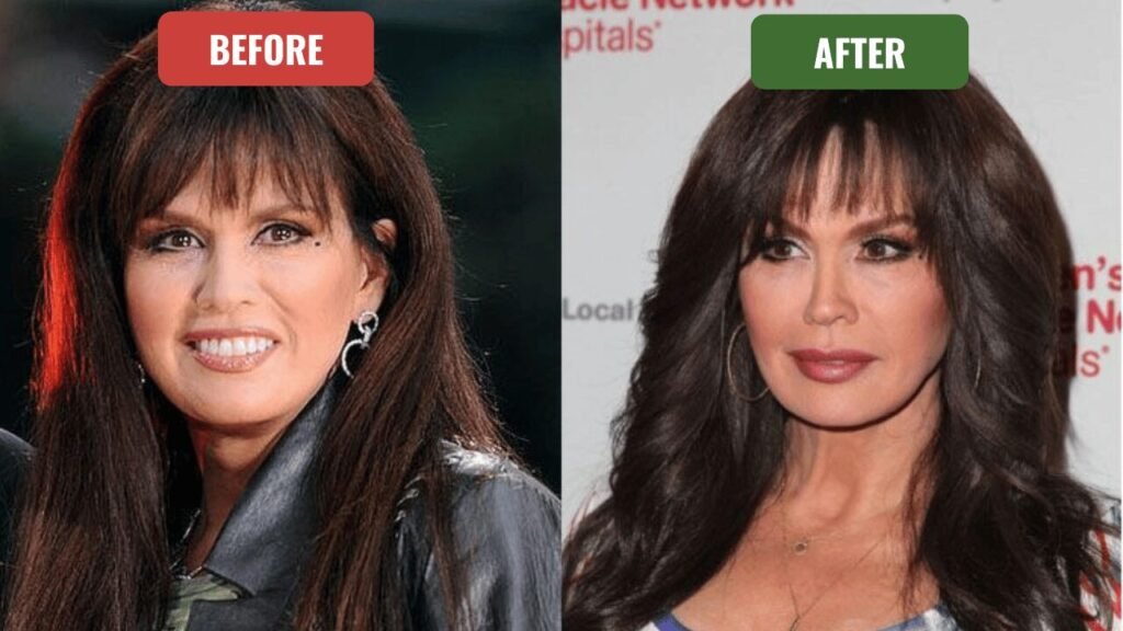 marie osmond plastic surgery