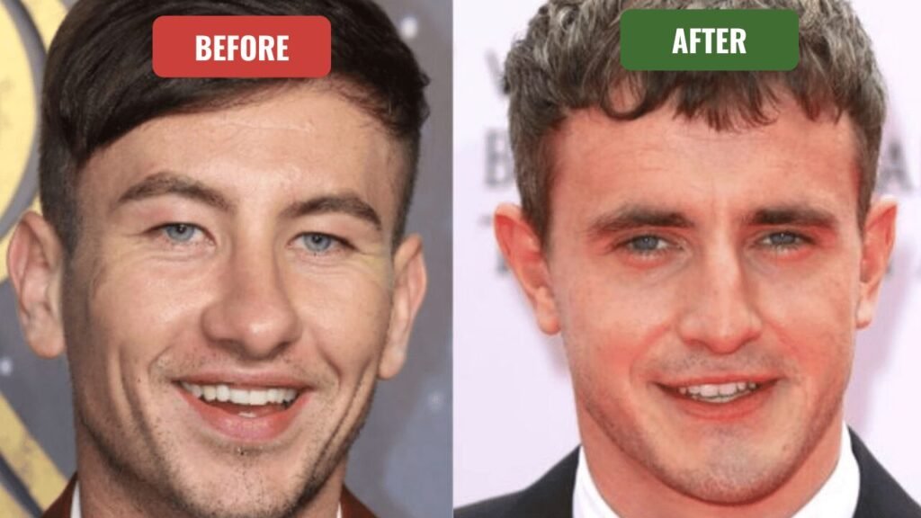 barry keoghan plastic surgery