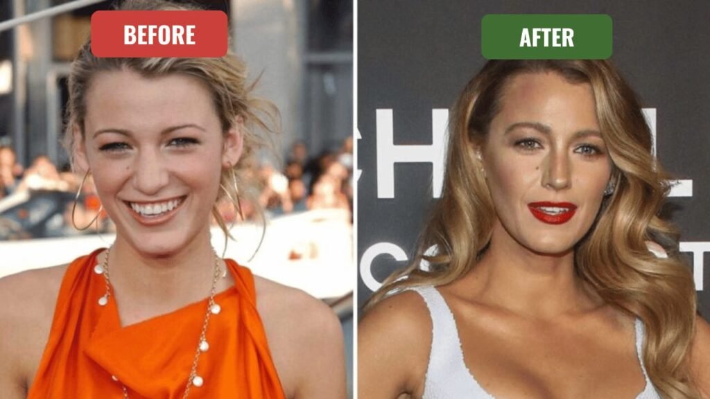 blake lively plastic surgery