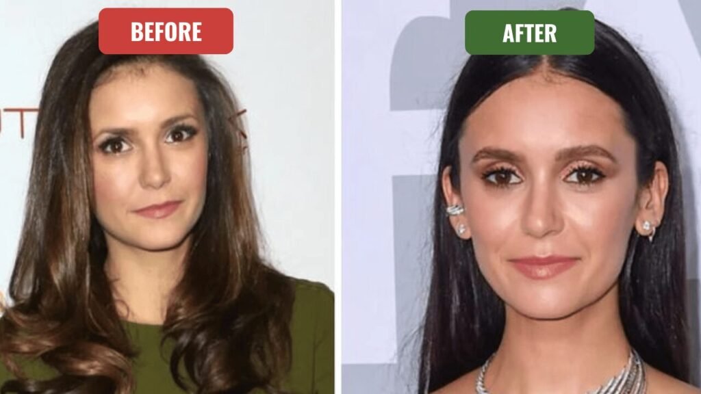 nina dobrev plastic surgery