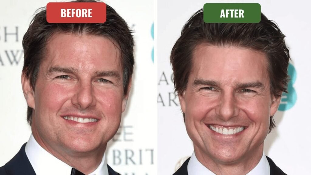 tom cruise plastic surgery