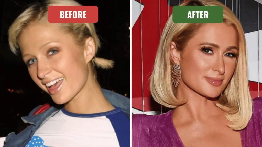 paris hilton plastic surgery