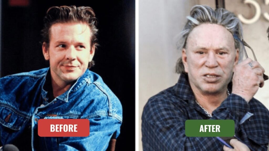 mickey rourke plastic surgery