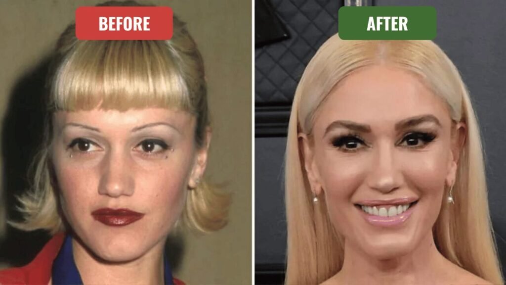 gwen stefani plastic surgery